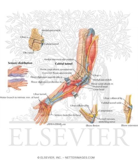 Ulnar Nerve Compression In the Cubital Tunnel