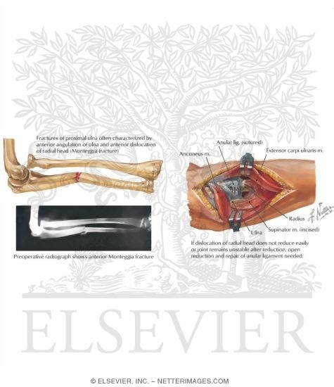 Watermarked preview of labeled image: Fracture of the Ulna Shaft