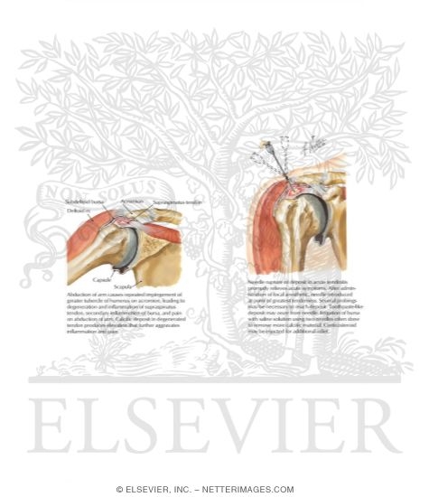 Watermarked preview of labeled image: Shoulder Tendinitis and Bursitis