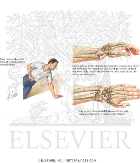 Watermarked preview of labeled image: Distal Radial (Colles') Fracture