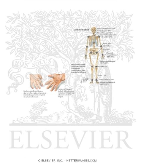 Watermarked preview of labeled image: Rheumatoid Arthritis