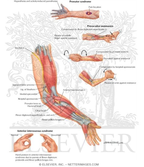 Proximal Compression of Median Nerve