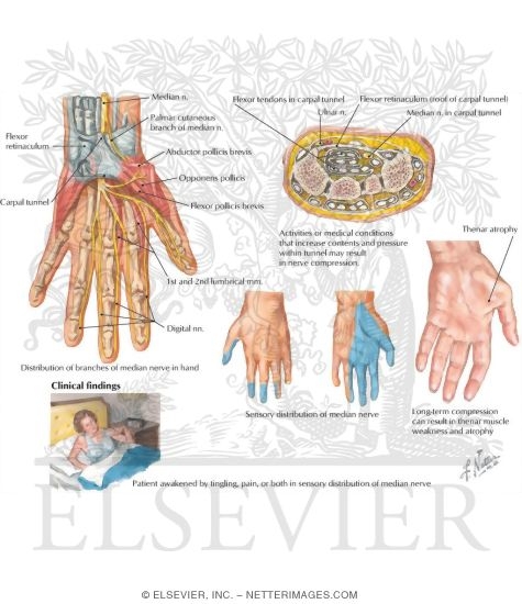 Watermarked preview of labeled image: Carpal Tunnel Syndrome