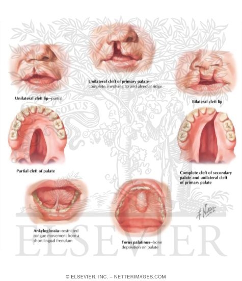 Congenital Anomalies of Oral