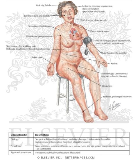 Primary and Secondary Adult Myxedema
Hypothyroidism