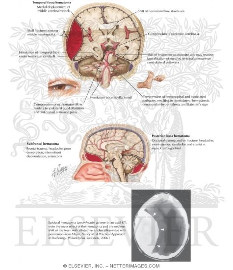 Epidural Hemorrhage