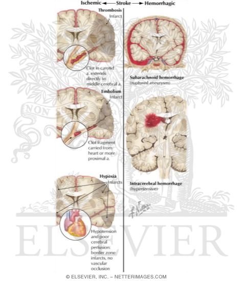 Diagnosis of Stroke
