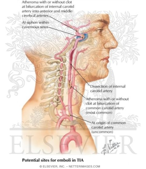 Stenosis or Occlusion of Carotid Artery
