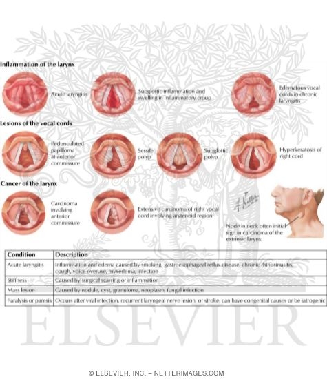 Hoarseness