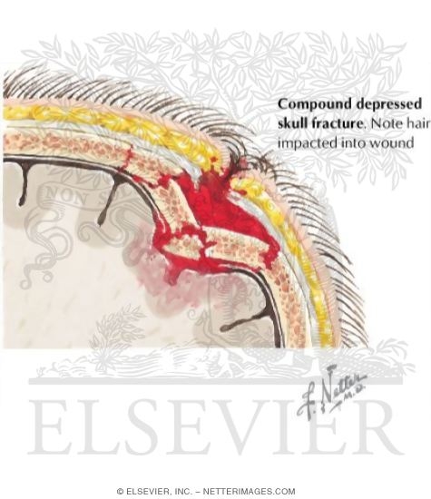 Compound Depressed Skull Fractures