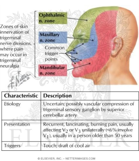 Trigeminal Neuralgia