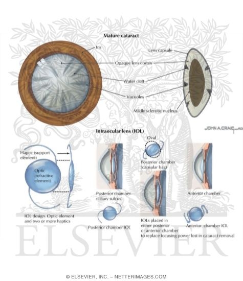 Cataract