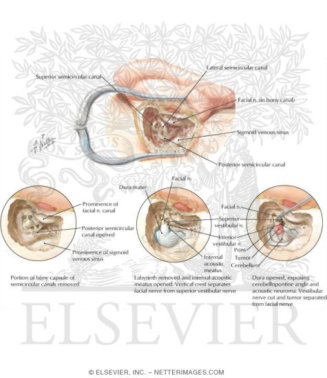 auditory nerve neuroma auditory nerve neuroma