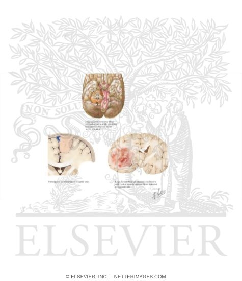 Watermarked preview of labeled image: Primary Brain Tumors