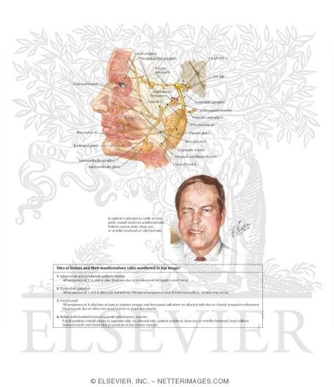 Watermarked preview of labeled image: Facial Nerve (Bell's) Palsy