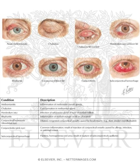 Eyelid Infections and Conjunctival Disorders