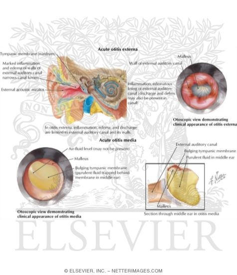 Acute Otitis Externa and Media