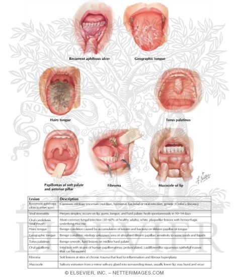 Watermarked preview of labeled image: Common Oral Lesions