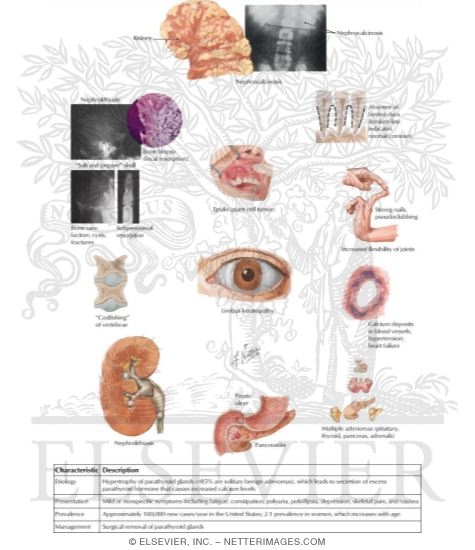 Watermarked preview of labeled image: Manifestations of Primary Hyperparathyroidism