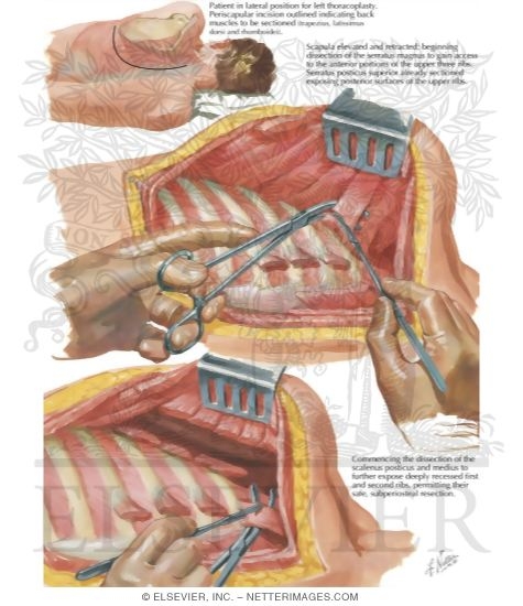 Watermarked preview of labeled image: Chest Surgery In Tuberculosis