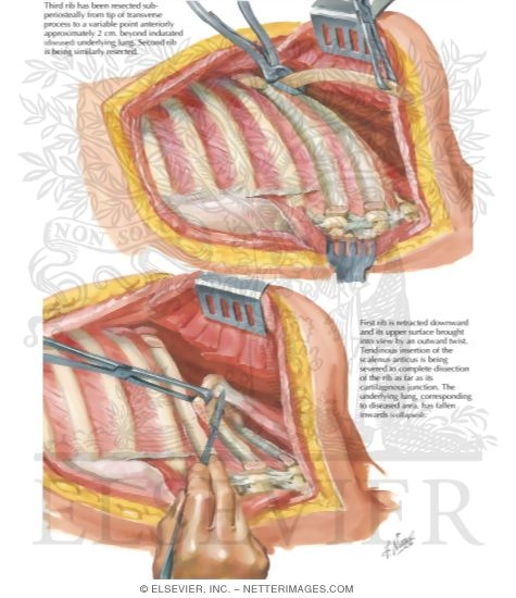Watermarked preview of labeled image: Chest Surgery In Tuberculosis