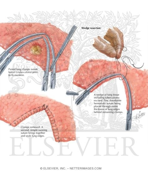 Watermarked preview of labeled image: Chest Surgery In Tuberculosis