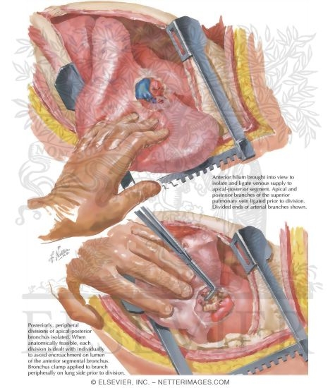 Watermarked preview of labeled image: Chest Surgery In Tuberculosis