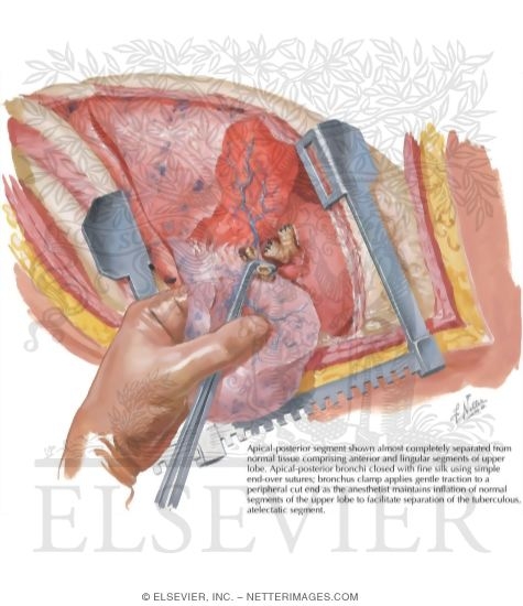 Watermarked preview of labeled image: Chest Surgery In Tuberculosis