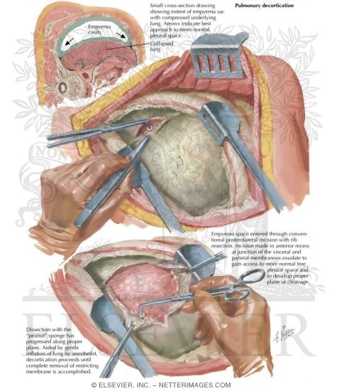 Watermarked preview of labeled image: Chest Surgery In Tuberculosis