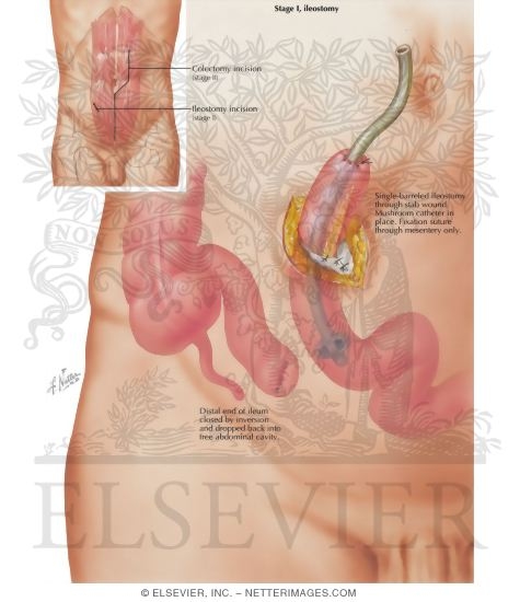 Watermarked preview of labeled image: Surgical Treatment of Chronic Ulcerative Colitis: Stage I, Ileostomy