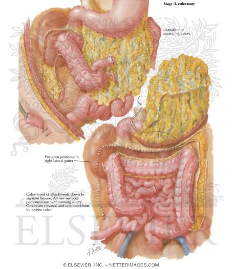 Watermarked preview of labeled image: Surgical Treatment of Chronic Ulcerative Colitis: Stage II, Colectomy