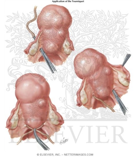 Watermarked preview of labeled image: Myomectomy In Treatment of Infertility