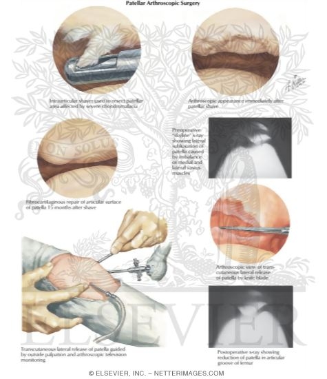Watermarked preview of labeled image: Arthroscopic Surgery of the Patella
