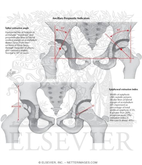 Watermarked preview of labeled image: Legg-Calve-Perthes' Disease: Ancillary Prognostic Indicators