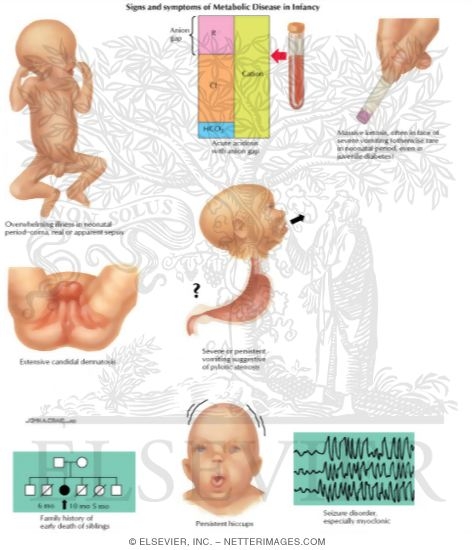 Watermarked preview of labeled image: Birth Defects: Signs and Symptoms of Metabolic Disease In Infancy