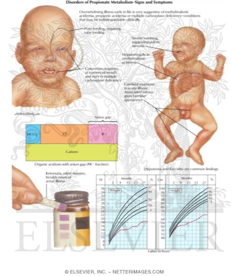 Defects: Disorders Of Propionate Metabolism Signs And Symptoms - 475x550 - jpeg Phenylketonuria Symptoms