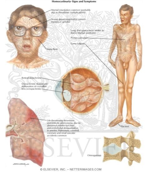 Birth Defects: Homocystinuria - Signs and Symptoms
