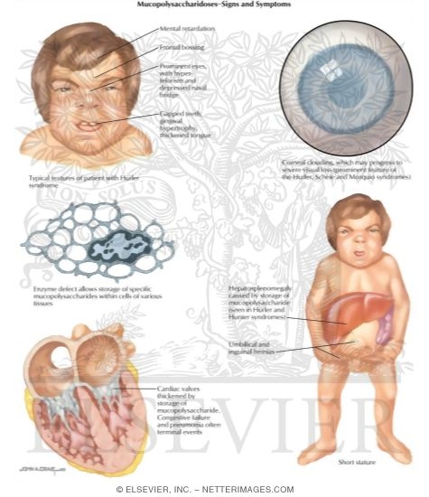 Watermarked preview of labeled image: Birth Defects Mucopolysaccharidoses-Signs And Symptoms