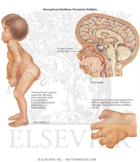Watermarked preview of labeled image: Birth Defects: Mucopolysaccharidoses - Dystosis Multiplex
