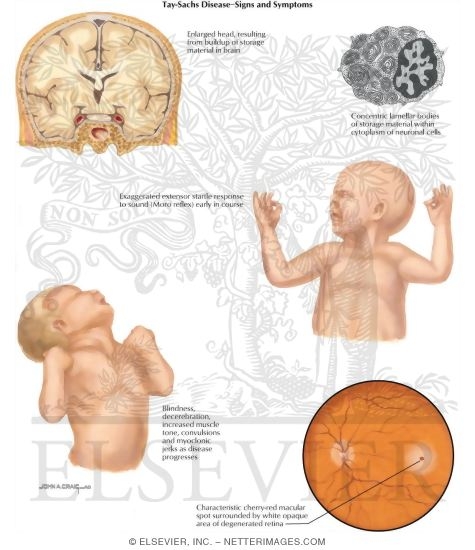 Tay-Sachs Disease: Signs and Symptoms