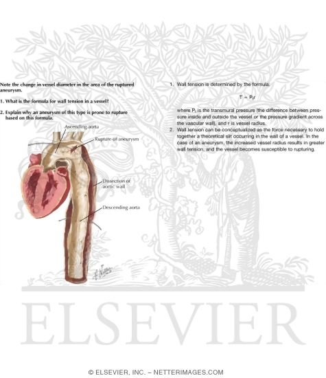 Watermarked preview of labeled image: Aortic Aneurysm