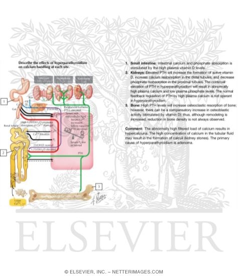 Watermarked preview of labeled image: Pathophysiology of Primary Hyperparathyroidism