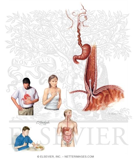 Watermarked preview of unlabeled image: Esophageal Spasm Syndromes