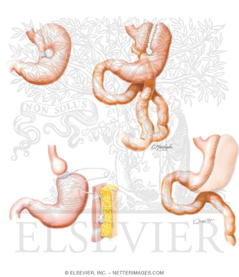 Watermarked preview of unlabeled image: Surgical Treatment Options for Obesity