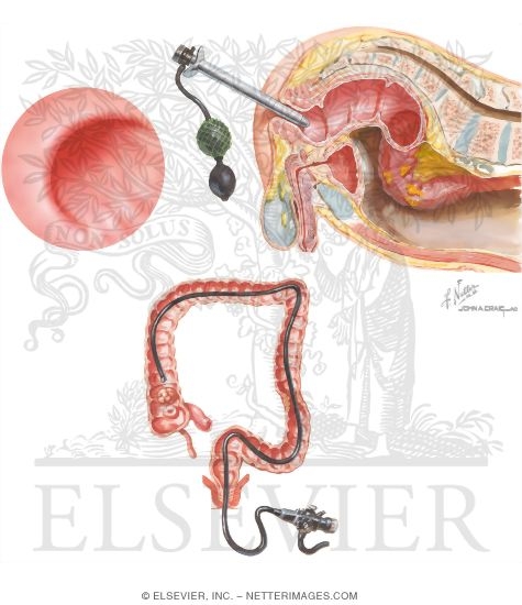 Anoscopy, Sigmoidoscopy and Colonoscopy