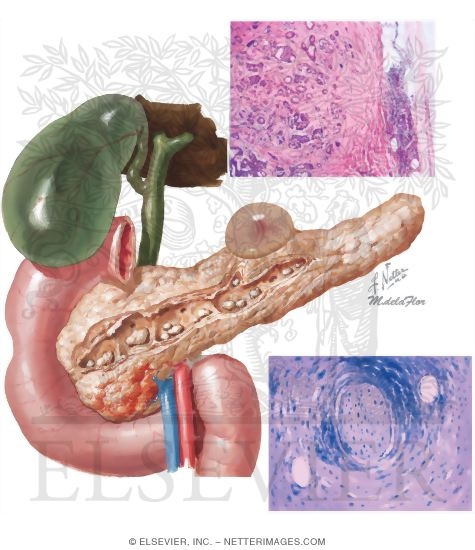 Watermarked preview of unlabeled image: Chronic Pancreatitis