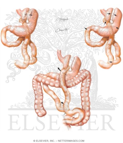 Watermarked preview of unlabeled image: Complications of Bariatric Surgery