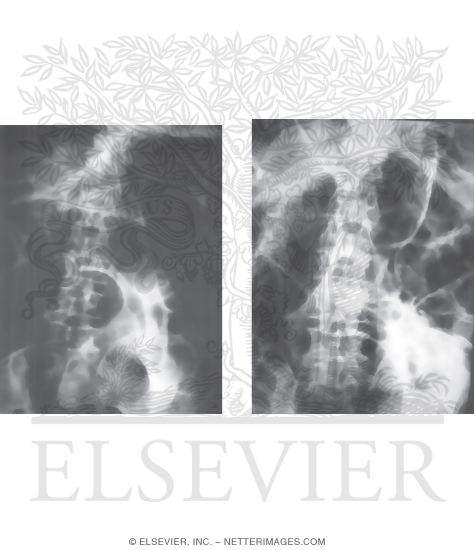 Chronic Intestinal Pseudo-Obstruction