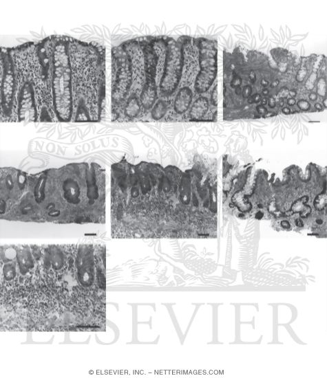 Ulcerative Colitis: Histologic Diagnosis and Dysplasia