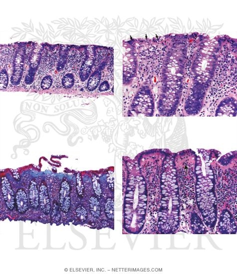 Microscopic Colitis Lymphocytic And Collagenous